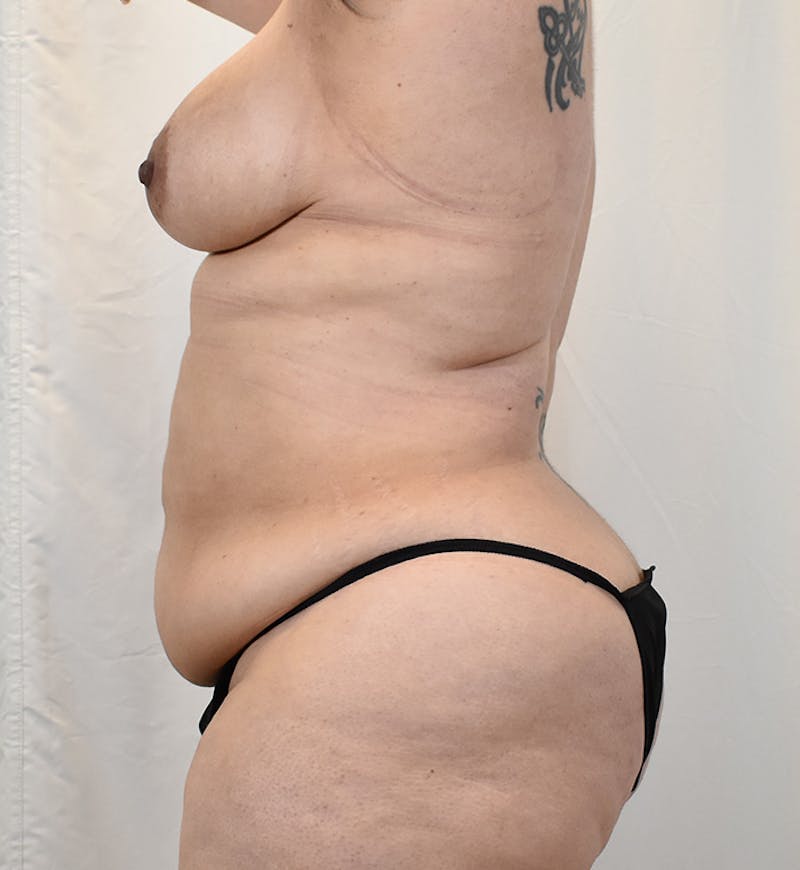 Tummy Tuck Before & After Gallery - Patient 293804 - Image 7
