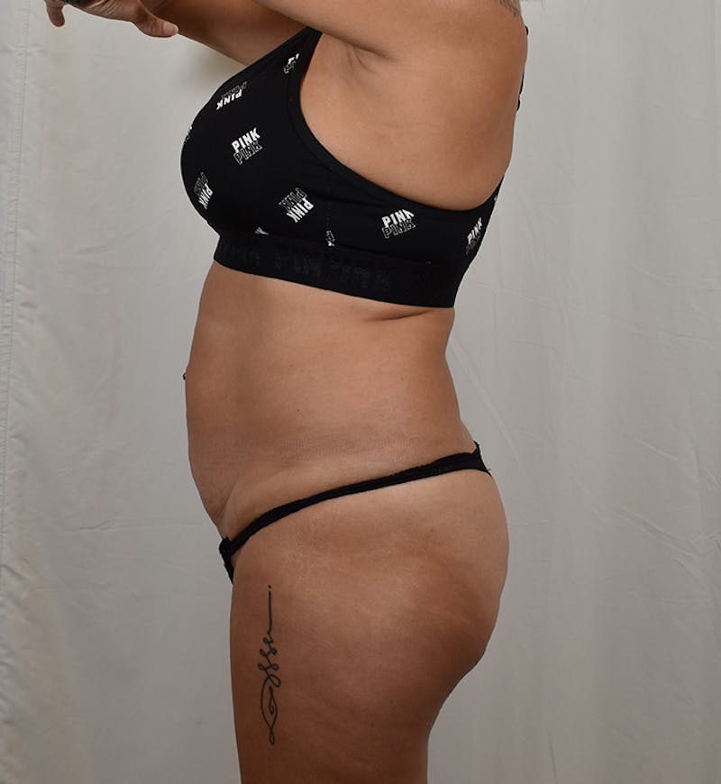Tummy Tuck Before & After Gallery - Patient 275567 - Image 5