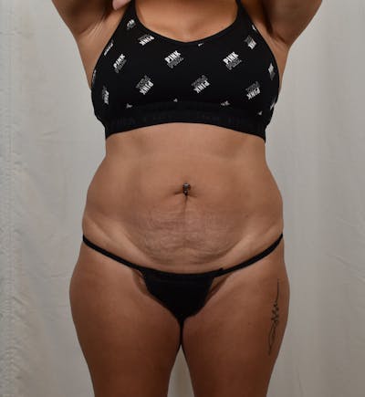 Tummy Tuck Before & After Gallery - Patient 275567 - Image 1