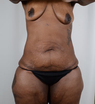 Body Lift Before & After Gallery - Patient 154983 - Image 1
