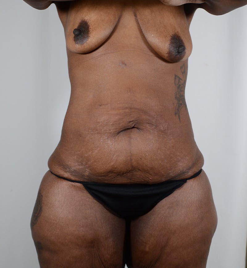 Body Lift Before & After Gallery - Patient 154983 - Image 1
