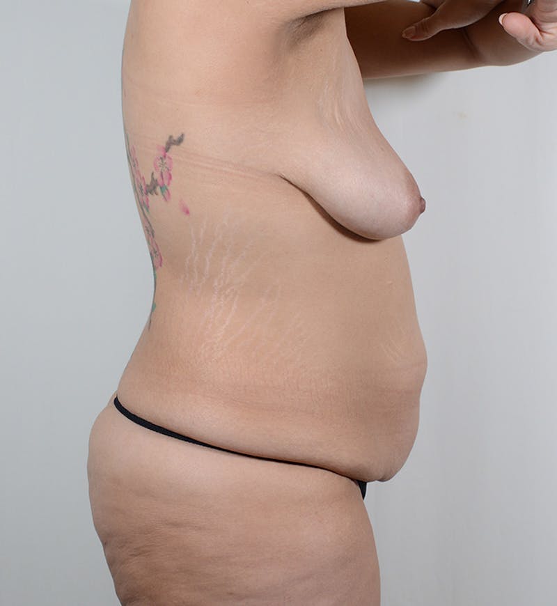 Body Lift Before & After Gallery - Patient 263143 - Image 3