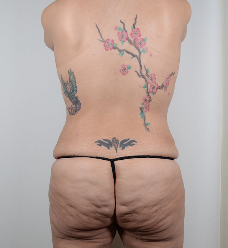 Body Lift Before & After Gallery - Patient 263143 - Image 7