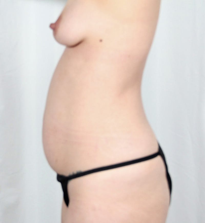 Body Lift Before & After Gallery - Patient 228065 - Image 9