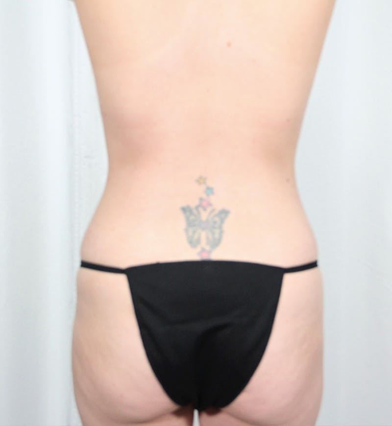 Body Lift Before & After Gallery - Patient 228065 - Image 11