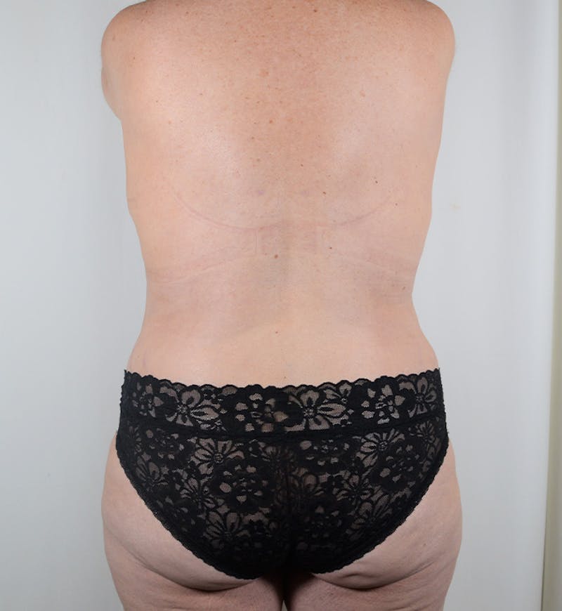 Body Lift Before & After Gallery - Patient 329471 - Image 8