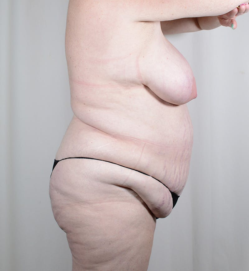 Body Lift Before & After Gallery - Patient 329471 - Image 3