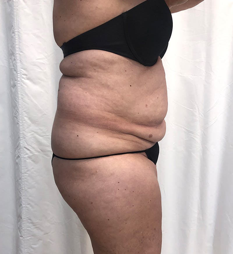Body Lift Before & After Gallery - Patient 274221 - Image 3