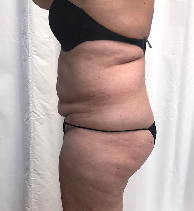 Body Lift Before & After Gallery - Patient 274221 - Image 5