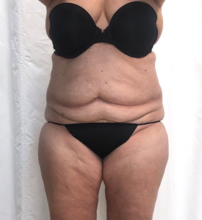 Body Lift Before & After Gallery - Patient 274221 - Image 1