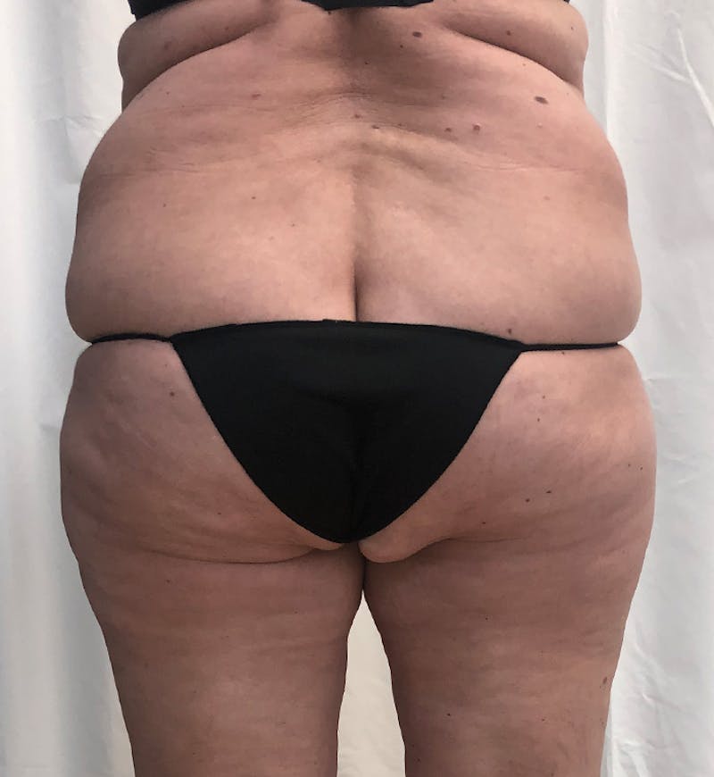 Body Lift Before & After Gallery - Patient 274221 - Image 7