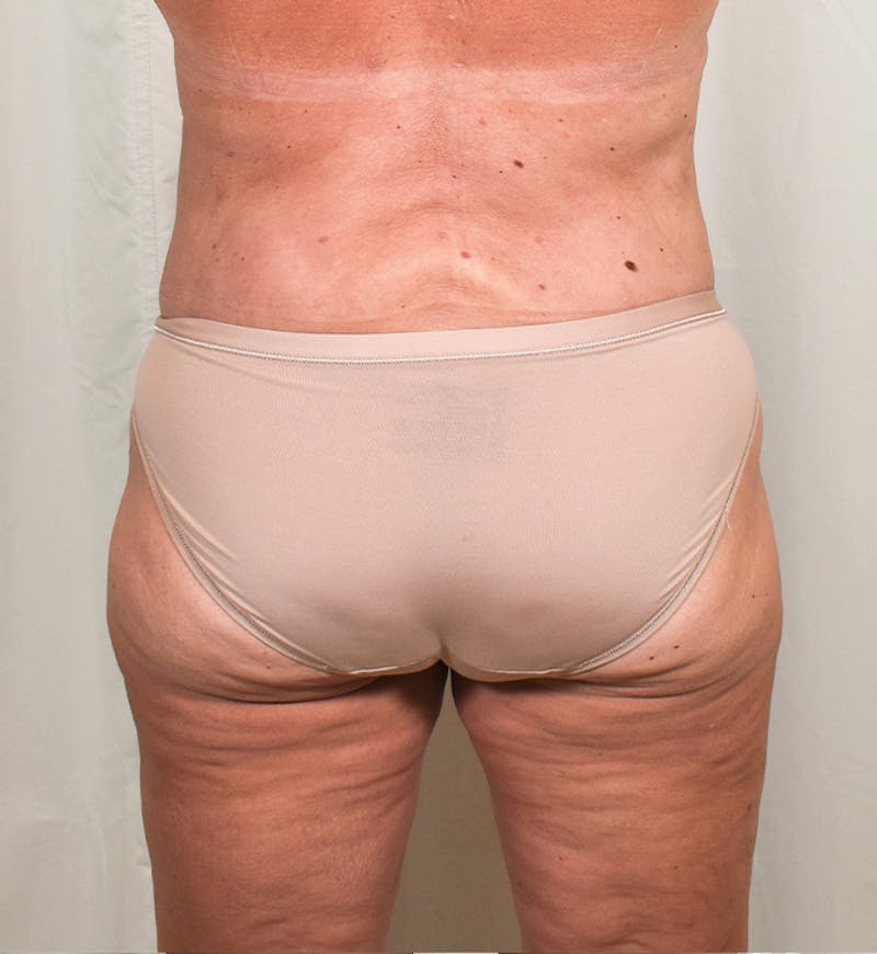Body Lift Before & After Gallery - Patient 274221 - Image 8
