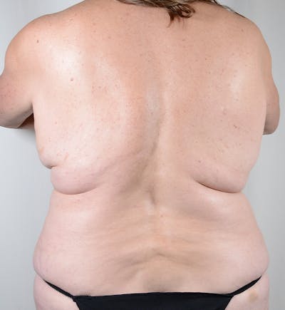 Bra Line Backlift Before & After Gallery - Patient 170589 - Image 1