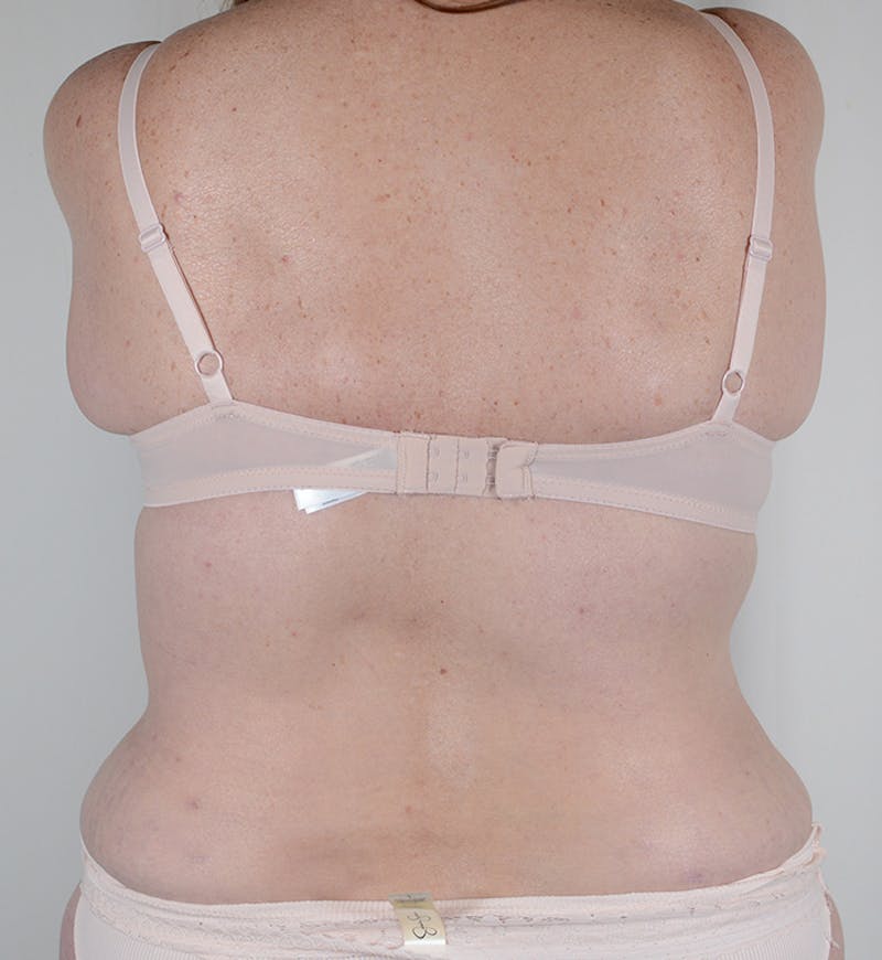 Bra Line Backlift Before & After Gallery - Patient 170589 - Image 4