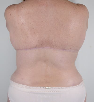 Bra Line Backlift Before & After Gallery - Patient 170589 - Image 2