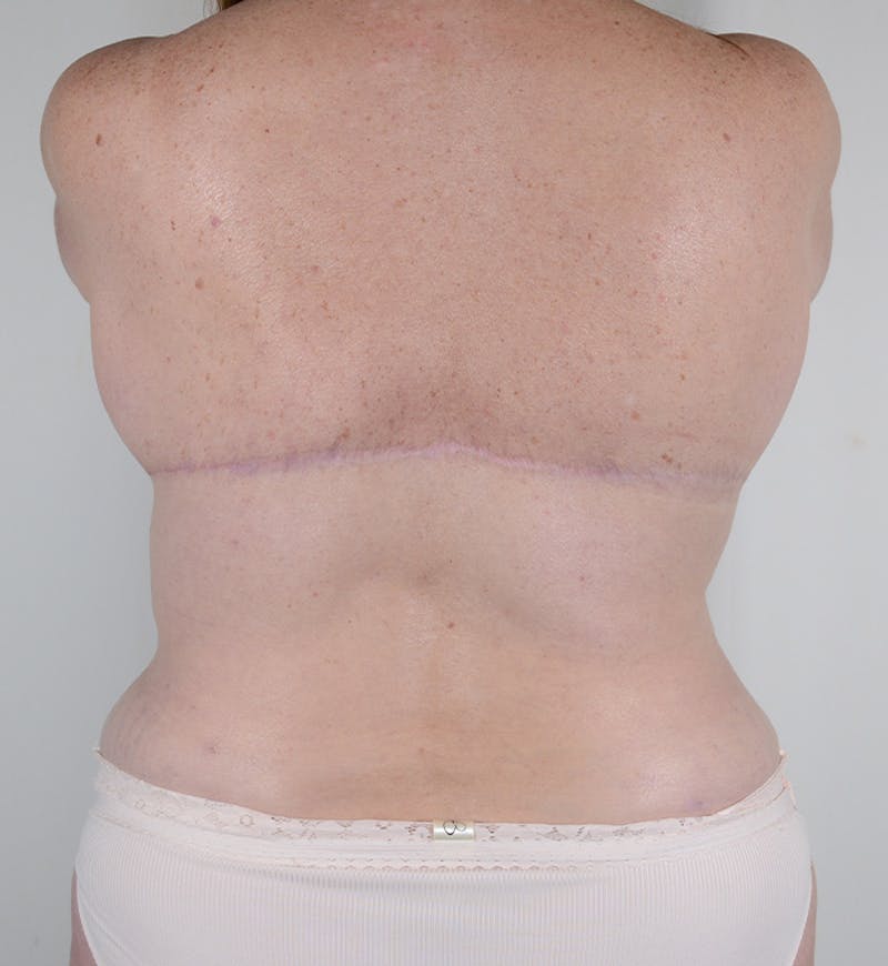Bra Line Backlift Before & After Gallery - Patient 170589 - Image 2