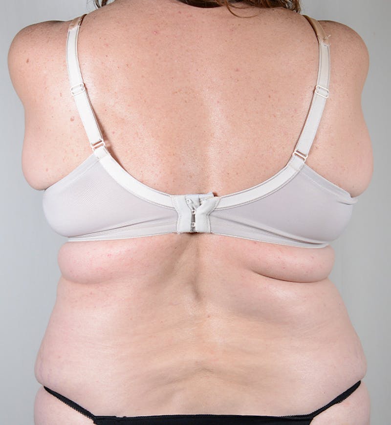 Bra Line Backlift Before & After Gallery - Patient 170589 - Image 3