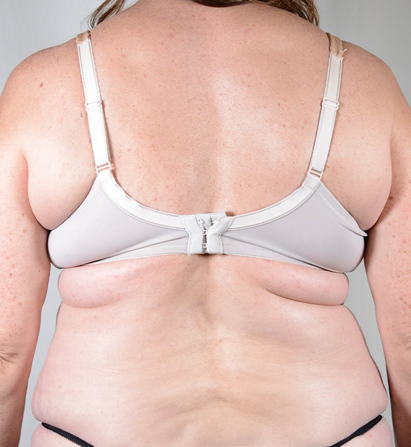 Bra Line Backlift Before & After Gallery - Patient 170589 - Image 5
