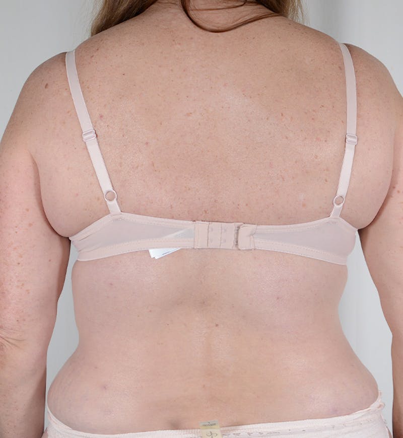 Bra Line Backlift Before & After Gallery - Patient 170589 - Image 6