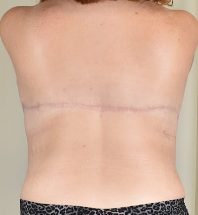 Bra Line Backlift Before & After Gallery - Patient 377526 - Image 2