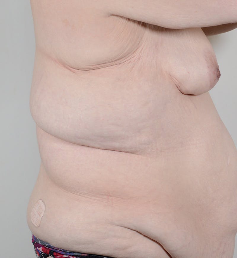 Bra Line Backlift Before & After Gallery - Patient 377526 - Image 3