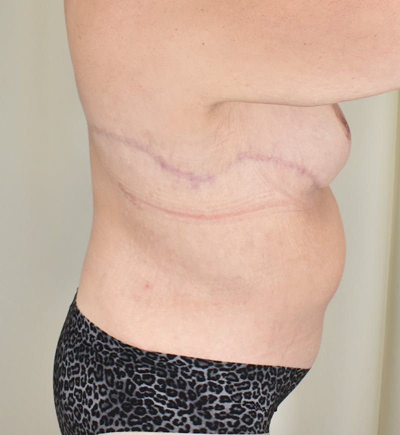 Bra Line Backlift Before & After Gallery - Patient 377526 - Image 4