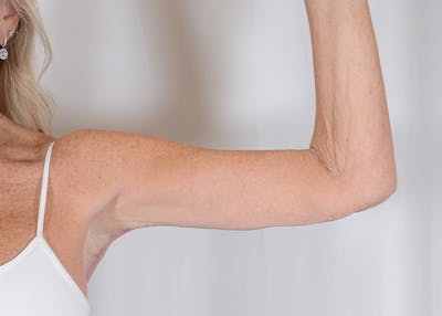 Arm Lift Before & After Gallery - Patient 325961 - Image 2