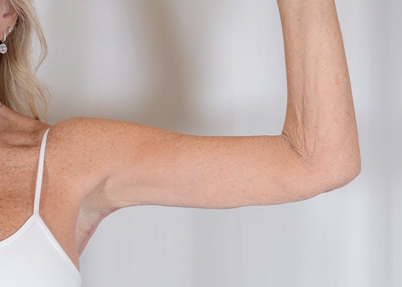 Arm Lift Before & After Gallery - Patient 325961 - Image 2