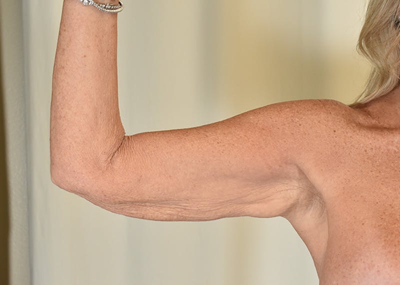 Arm Lift Before & After Gallery - Patient 325961 - Image 5