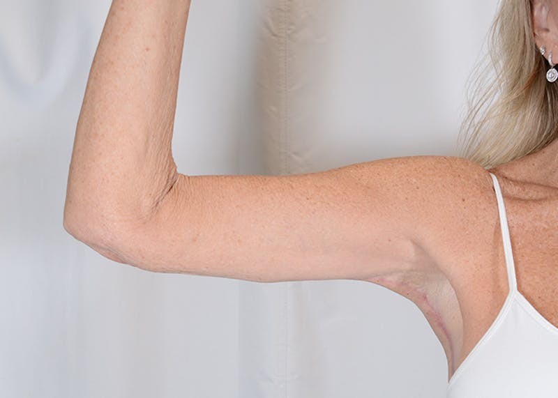 Arm Lift Before & After Gallery - Patient 325961 - Image 6
