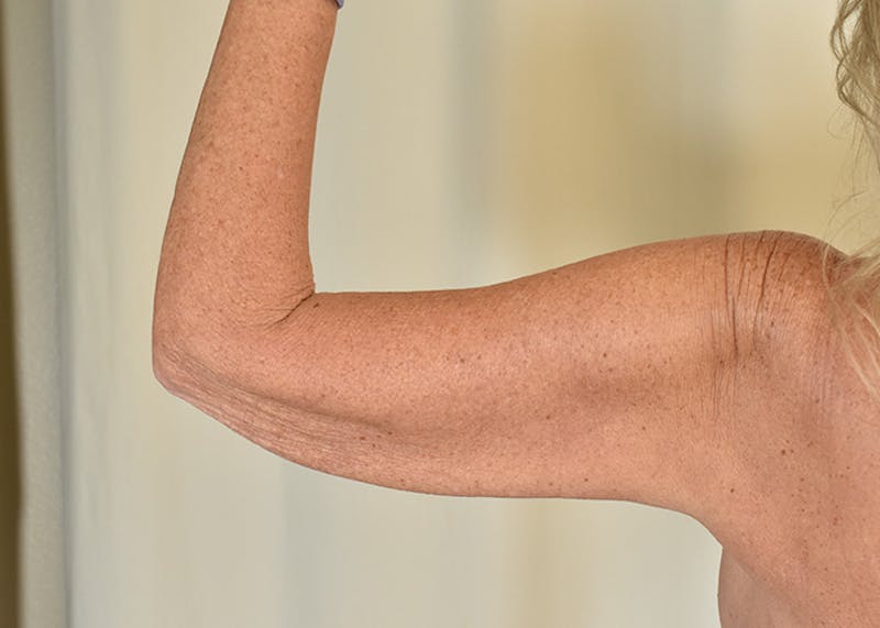 Arm Lift Before & After Gallery - Patient 325961 - Image 7
