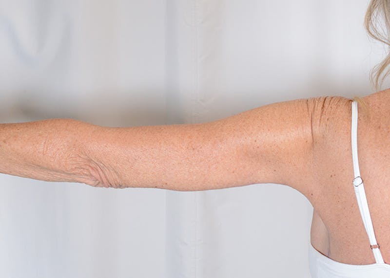 Arm Lift Before & After Gallery - Patient 325961 - Image 8