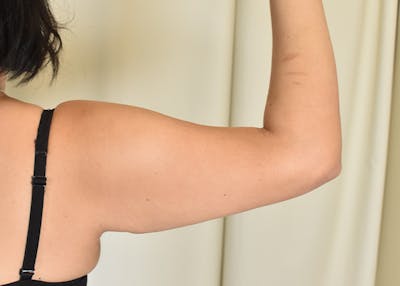 Arm Lift Before & After Gallery - Patient 404459 - Image 1