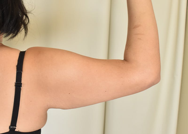 Arm Lift Before & After Gallery - Patient 404459 - Image 1