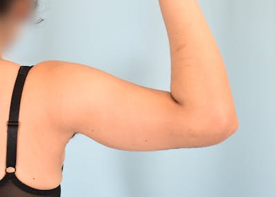Arm Lift Before & After Gallery - Patient 404459 - Image 2