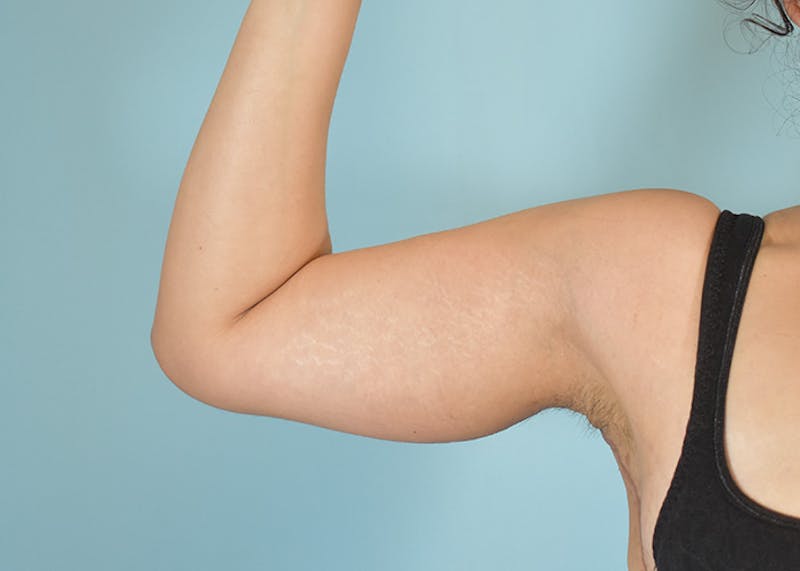 Arm Lift Before & After Gallery - Patient 404459 - Image 8