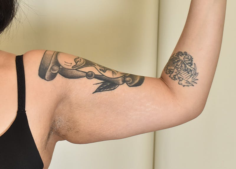 Arm Lift Before & After Gallery - Patient 404459 - Image 3