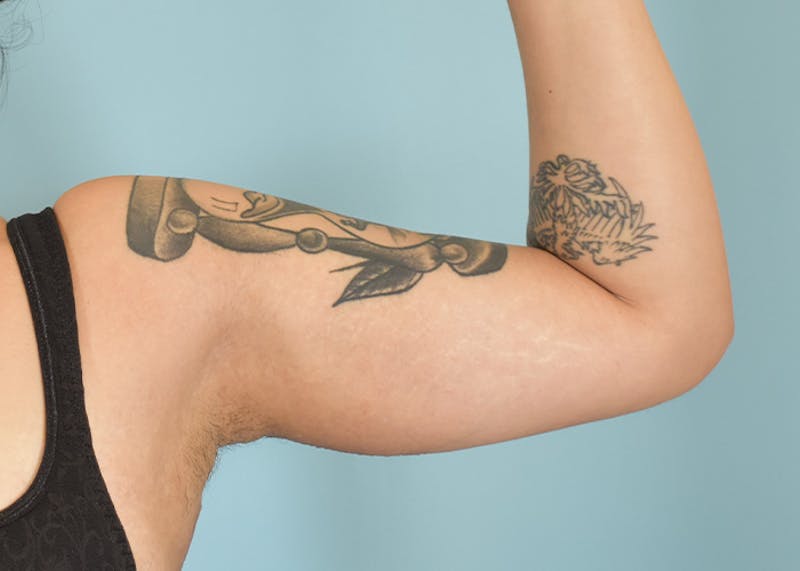 Arm Lift Before & After Gallery - Patient 404459 - Image 4
