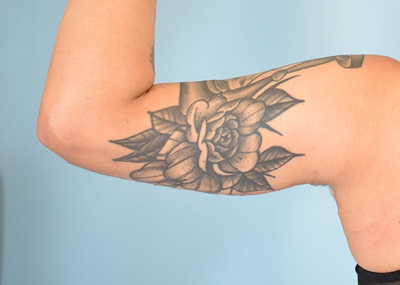 Arm Lift Before & After Gallery - Patient 404459 - Image 6