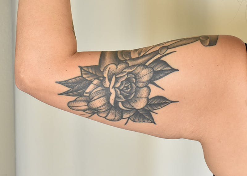 Arm Lift Before & After Gallery - Patient 404459 - Image 5