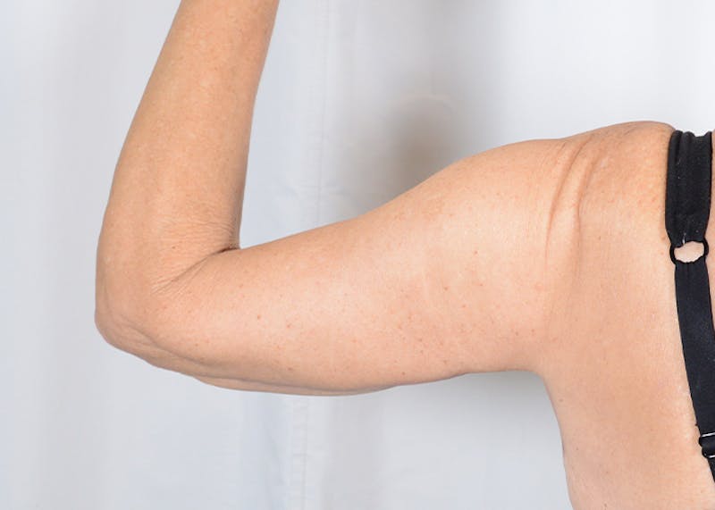 Arm Lift Before & After Gallery - Patient 203622 - Image 6