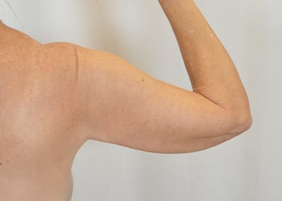 Arm Lift Before & After Gallery - Patient 203622 - Image 1