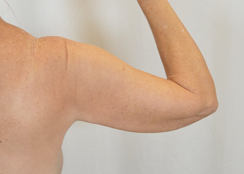 Arm Lift Before & After Gallery - Patient 203622 - Image 1