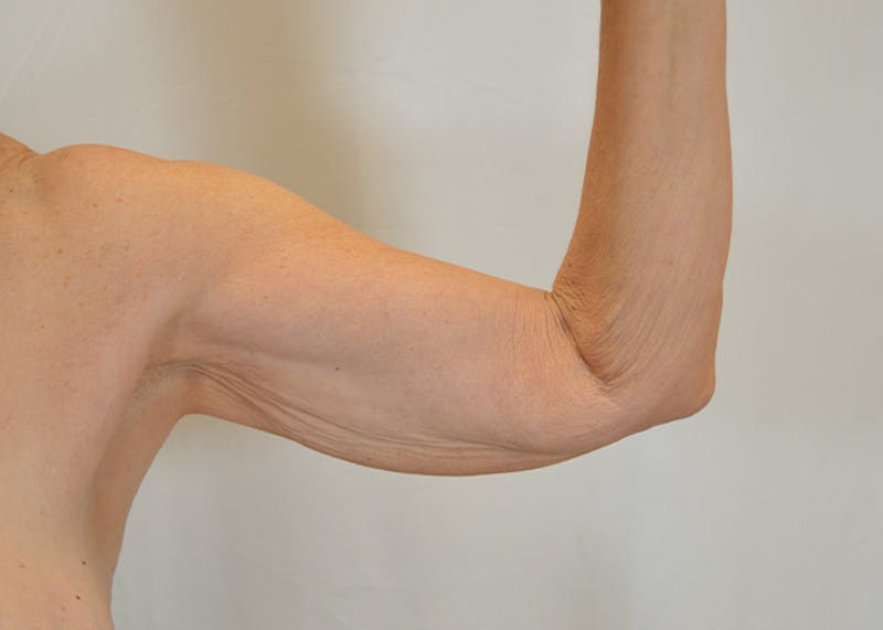 Arm Lift Before & After Gallery - Patient 203622 - Image 3