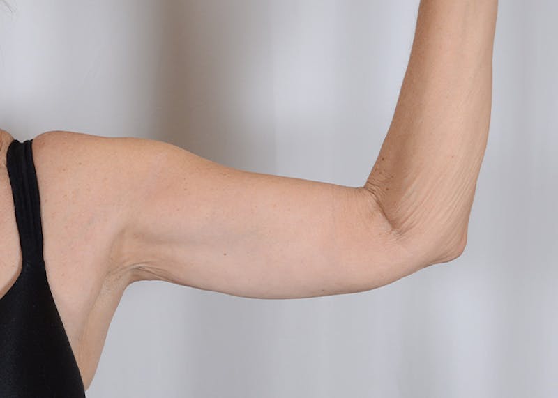 Arm Lift Before & After Gallery - Patient 203622 - Image 4