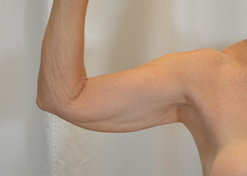 Arm Lift Before & After Gallery - Patient 203622 - Image 7
