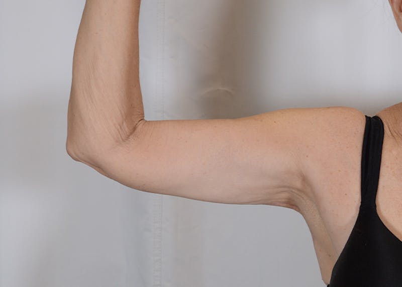Arm Lift Before & After Gallery - Patient 203622 - Image 8