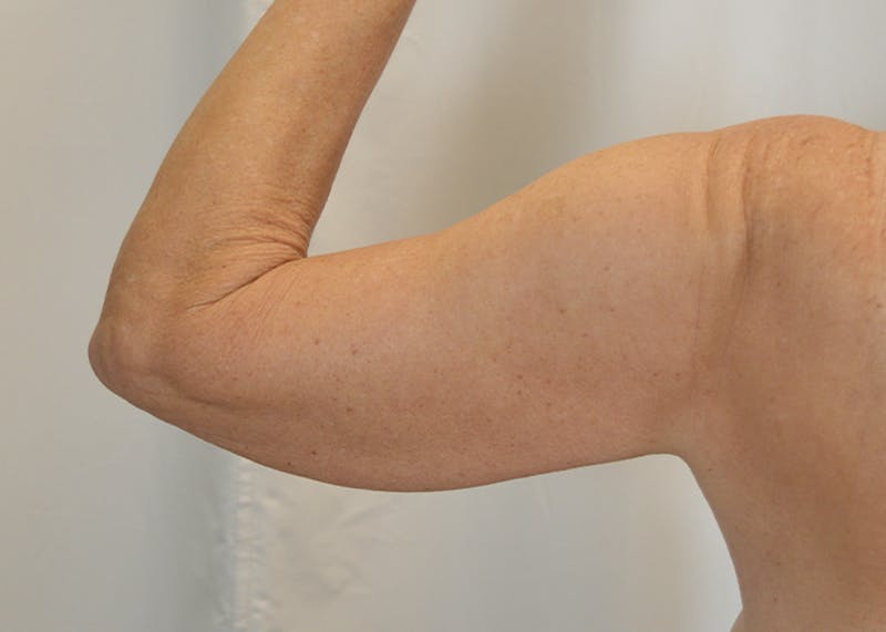 Arm Lift Before & After Gallery - Patient 203622 - Image 5