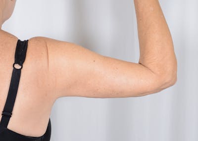 Arm Lift Before & After Gallery - Patient 203622 - Image 2