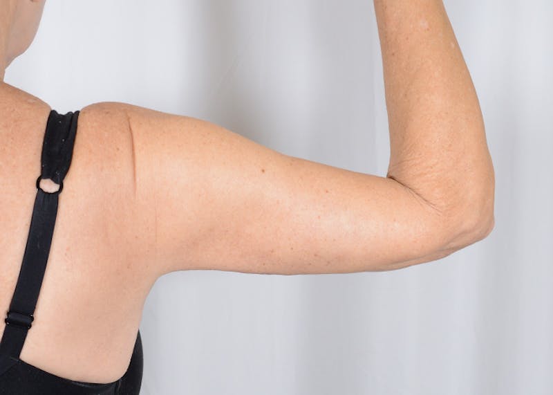 Arm Lift Before & After Gallery - Patient 203622 - Image 2